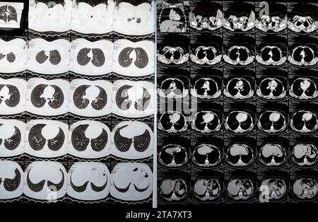 Kairo, Ägypten, 15. Oktober 2023: CT-Scan axialer Schnitte durch den Brustkorb mit Kontrastmittelinjektion mit niedrigem Grad an Entzündungsreaktion, parenchymalen Venen Stockfoto