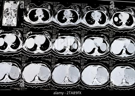 Kairo, Ägypten, 3. Oktober 2023: Mehrschicht-CT-Scan Abdomen und Becken zeigt rechte Ovarialzyste 3 x 3 cm, gasförmige Distension des Kolons, keine nennenswerte Harnmenge Stockfoto