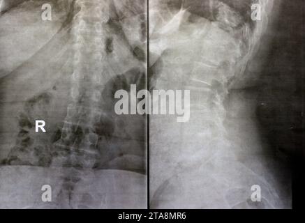 Das einfache Röntgenbild der dorsalen und der Holzwirbelsäule zeigt spondylotische Veränderungen, die Begradigung der dorsalen und der Holzwirbelsäule, die Bandscheibenräume sind intakt, Stockfoto