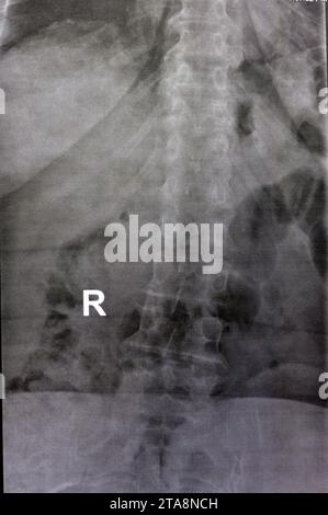 Das einfache Röntgenbild der dorsalen und der Holzwirbelsäule zeigt spondylotische Veränderungen, die Begradigung der dorsalen und der Holzwirbelsäule, die Bandscheibenräume sind intakt, Stockfoto