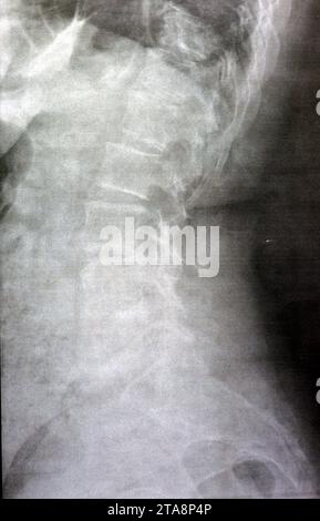 Das einfache Röntgenbild der dorsalen und der Holzwirbelsäule zeigt spondylotische Veränderungen, die Begradigung der dorsalen und der Holzwirbelsäule, die Bandscheibenräume sind intakt, Stockfoto