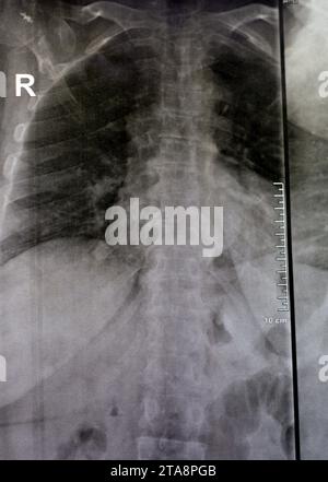 Das einfache Röntgenbild der dorsalen und der Holzwirbelsäule zeigt spondylotische Veränderungen, die Begradigung der dorsalen und der Holzwirbelsäule, die Bandscheibenräume sind intakt, Stockfoto