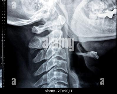 Die Röntgenaufnahme der Halswirbelsäule zeigte eine begradigte Halswirbelkurve, Spondylose osteophytische Lippen der Endplatten C3, C4, C5, schmale Bandscheibe sp Stockfoto