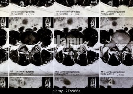 MRT der lumbosakralen Wirbelsäule ohne Kontrastmittel zeigte Rückenmuskelkrämpfe, leichte L3-L4-, L4-L5-Bandscheibenläsionen, Sakral-, L5- und T12-Wirbelkörper Hämangiomata, Stockfoto