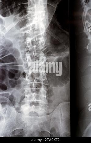 Die digitale Röntgenuntersuchung der Lumbosakralen Wirbelsäule zeigt eine begradigte lordotische Kurve der Lumbosakralwirbelsäule und eine marginale osteophytische Lippung der L4-Endplatte Stockfoto