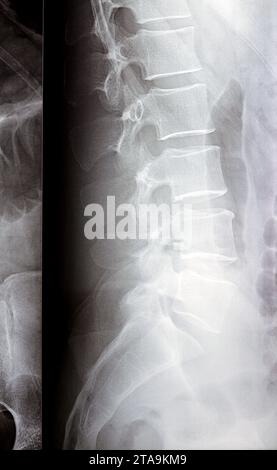 Die digitale Röntgenuntersuchung der Lumbosakralen Wirbelsäule zeigt eine begradigte lordotische Kurve der Lumbosakralwirbelsäule und eine marginale osteophytische Lippung der L4-Endplatte Stockfoto