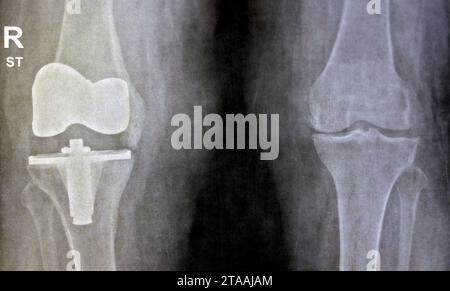 Einfache Röntgenaufnahme der Kniegelenke, rechte Seite zeigt eine totale Kniegelenksersatzprothese nach Gelenkarthrose Grad 4, ein chirurgisches Verfahren zur Ersetzung von t Stockfoto