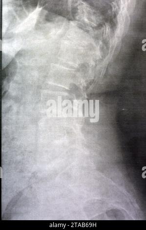 Das einfache Röntgenbild der dorsalen und der Holzwirbelsäule zeigt spondylotische Veränderungen, die Begradigung der dorsalen und der Holzwirbelsäule, die Bandscheibenräume sind intakt, Stockfoto