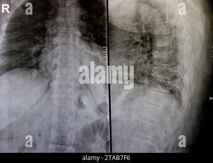 Das einfache Röntgenbild der dorsalen und der Holzwirbelsäule zeigt spondylotische Veränderungen, die Begradigung der dorsalen und der Holzwirbelsäule, die Bandscheibenräume sind intakt, Stockfoto