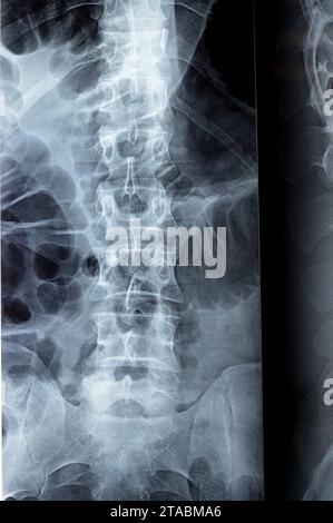 Die digitale Röntgenuntersuchung der Lumbosakralen Wirbelsäule zeigt eine begradigte lordotische Kurve der Lumbosakralwirbelsäule und eine marginale osteophytische Lippung der L4-Endplatte Stockfoto