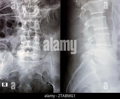 Die digitale Röntgenuntersuchung der Lumbosakralen Wirbelsäule zeigt eine begradigte lordotische Kurve der Lumbosakralwirbelsäule und eine marginale osteophytische Lippung der L4-Endplatte Stockfoto