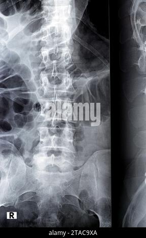 Die digitale Röntgenuntersuchung der Lumbosakralen Wirbelsäule zeigt eine begradigte lordotische Kurve der Lumbosakralwirbelsäule und eine marginale osteophytische Lippung der L4-Endplatte Stockfoto