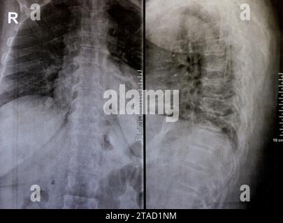 Das einfache Röntgenbild der dorsalen und der Holzwirbelsäule zeigt spondylotische Veränderungen, die Begradigung der dorsalen und der Holzwirbelsäule, die Bandscheibenräume sind intakt, Stockfoto