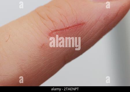 Ein heilender Kratzer am Finger eines Mannes. Finger tut weh, Nahaufnahme eines Kratzers am Finger. Stockfoto