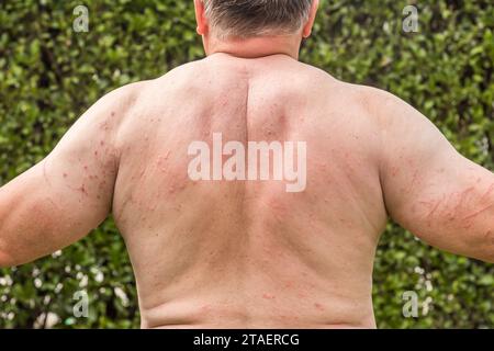 Rücken und Arme des Mannes mit Hautausschlag auf, Symptome des Juckens, Hautallergie. Stockfoto