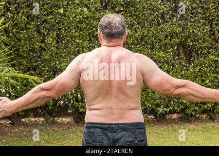 Rücken und Arme des Mannes mit Hautausschlag auf, Symptome des Juckens, Hautallergie. Stockfoto