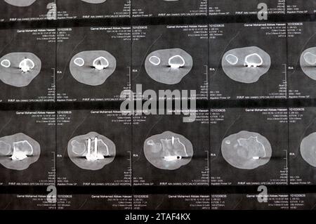 Kairo, Ägypten, 18. Oktober 2023: CT-Scan des linken Handgelenks zeigt eine kürzlich erfolgte Spaltfraktur am unteren Teil eines linken Radius, eine frühere innere Stockfoto