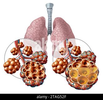 Lungenpneumonie und Lungenalveolen mit Flüssigkeits- oder Alveolusentzündungsanatomie als medizinisches Konzept einer Lungenanatomie Stockfoto