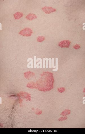 Psoriasis vulgaris, Hautflecken sind in der Regel rot, juckend und schuppig. Stockfoto