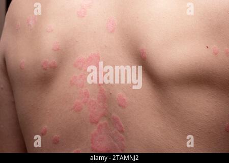 Psoriasis vulgaris, Hautflecken sind in der Regel rot, juckend und schuppig. Stockfoto