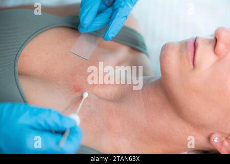 Dermatologe bei Hautprobe Stockfoto