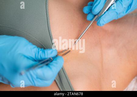 Dermatologe bei Hautprobe Stockfoto