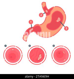 Magengeschwüre, konzeptuelle Illustration Stockfoto
