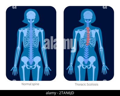 Gesunde Wirbelsäule und Skoliose, Illustration Stockfoto