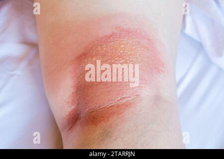 Probe von atopischer Dermatitis - Ekzemedermatitis unter Knie Nahaufnahme Stockfoto