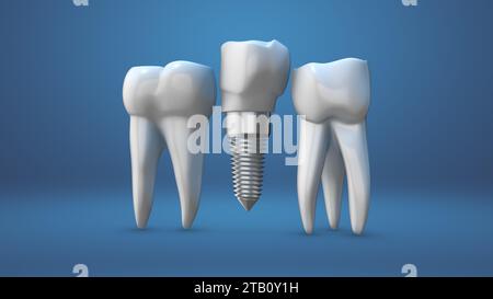 Zahnimplantat und Krone Installationsprozess Stockfoto