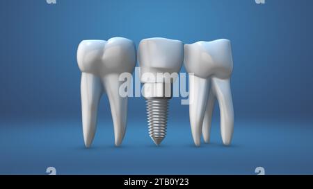 Zahnimplantat und Krone Installationsprozess Stockfoto