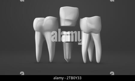 Zahnimplantat und Krone Installationsprozess Stockfoto