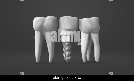 Zahnimplantat und Krone Installationsprozess Stockfoto