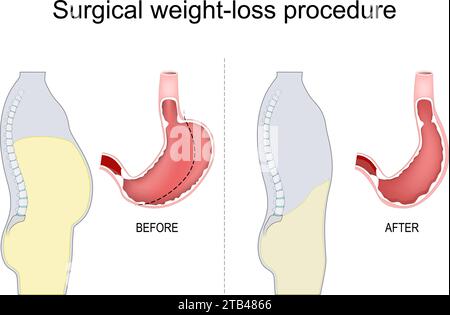 Vertikalärmel-Gastrektomie. Magenreduktion. Chirurgisches Vorgehen. Bariatrische Chirurgie. Adipositas-Behandlung. Vektorabbildung Stock Vektor