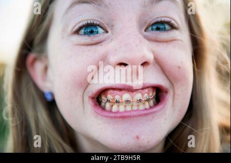 Teenager zeigt ihre Zahnspange; Lincoln, Nebraska, Vereinigte Staaten von Amerika Stockfoto