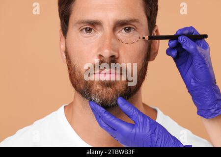 Der Arzt zeichnet Markierungen auf dem Gesicht des Mannes für die kosmetische Chirurgie vor beigem Hintergrund Stockfoto