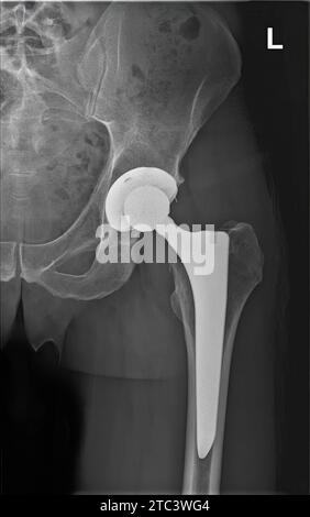Röntgenaufnahme der linken Hüftprothese des Menschen. Hüfttotalersatz Stockfoto