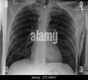 Thoraxröntgenaufnahme mit Lunge, Brustwirbelsäule und Brustkäfig Stockfoto