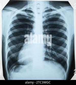 Thoraxröntgenaufnahme einer Frau mit Lunge, Brustwirbelsäule und Brustkäfig Stockfoto