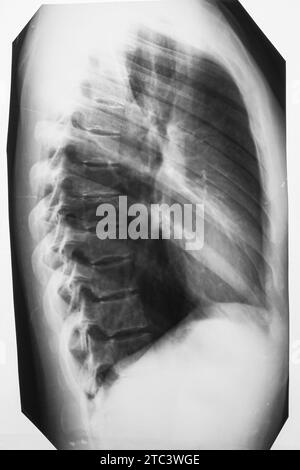 Thoraxröntgenaufnahme einer Frau mit Lunge, Brustwirbelsäule und Brustkäfig Stockfoto