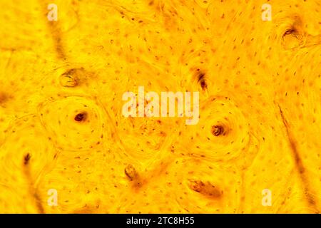 Kortikales Knochengewebe mit Haversischen Kanälen, Osteonen, Osteozyten und Mineralmatrix. Lichtmikroskop X300 mit einer Breite von 10 cm. Stockfoto