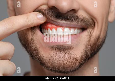 Mann mit entzündetem Kaugummi auf grauem Hintergrund, Nahaufnahme Stockfoto