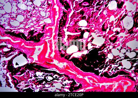 Menschliche Raucherlunge mit Anthrakose. Optisches Mikroskop X40. Stockfoto