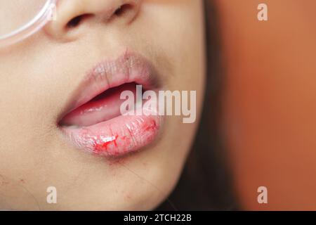 Nahaufnahme der trockenen Lippe eines Kindes Stockfoto