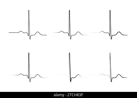 Ventrikuläre Repolarisation, Herzzyklus, EKG des Herzens bei normalem Sinusrhythmus, QT-Intervall des EKGs. Stock Vektor