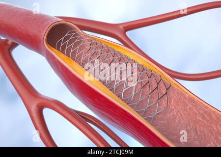 Die koronare Angioplastie mit Stenting (perkutane Koronarintervention oder PCI) verbessert die Blutversorgung des Herzens. 3D-Animation Stockfoto