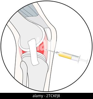 Knieinjektion. Stilisiertes Piktogramm für Web-Design oder mobile App über prp Biotechnologie, Hyaluronsäure-Injektion oder medizinisches Verfahren für Osteoart Stock Vektor