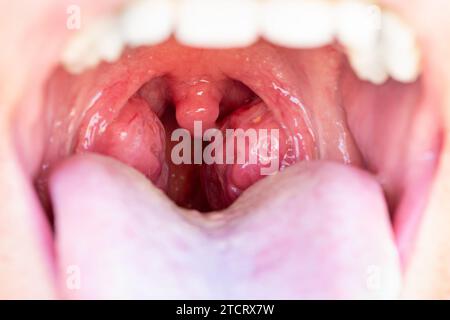Nahaufnahme des offenen Mundes mit Mandeln. Das Kind ist ein Patient mit großen roten Drüsen. Tonsillen im Nahaufnahme im Mund. Stockfoto