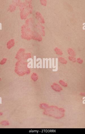 Psoriasis vulgaris, Hautflecken sind in der Regel rot, juckend und schuppig. Stockfoto