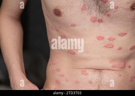 Psoriasis vulgaris, Hautflecken sind in der Regel rot, juckend und schuppig. Stockfoto